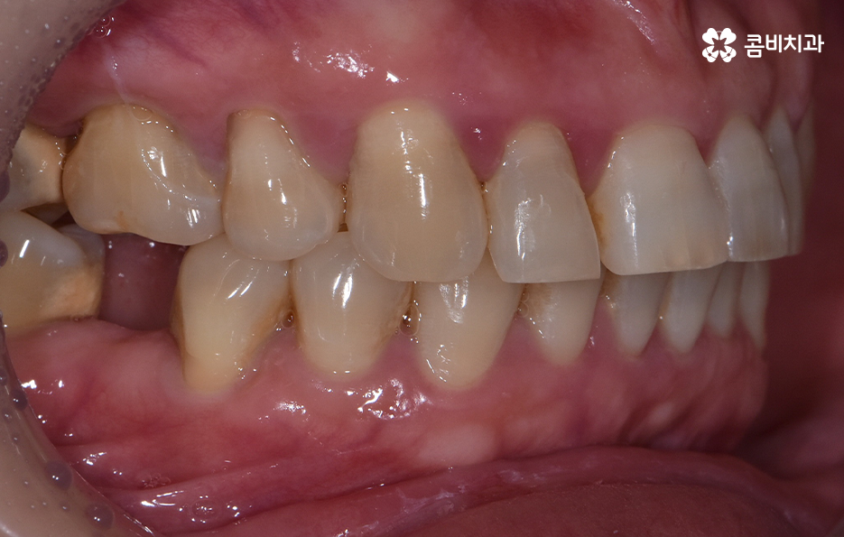 임플란트 해야 하는데 치아교정이 하고 싶다면 관련 이미지 3