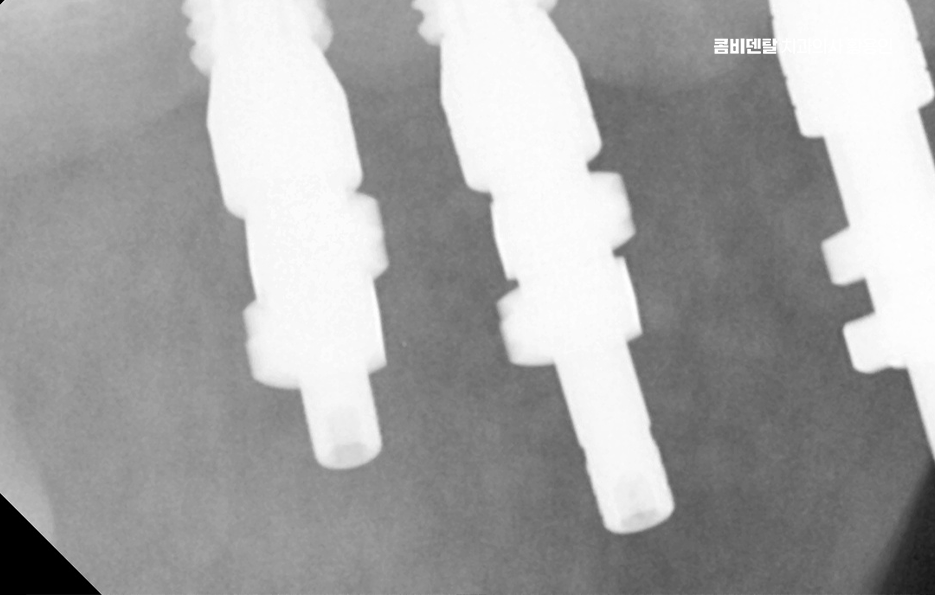 If You’re Considering Full Upper-Arch Implants for the Long Term image 7