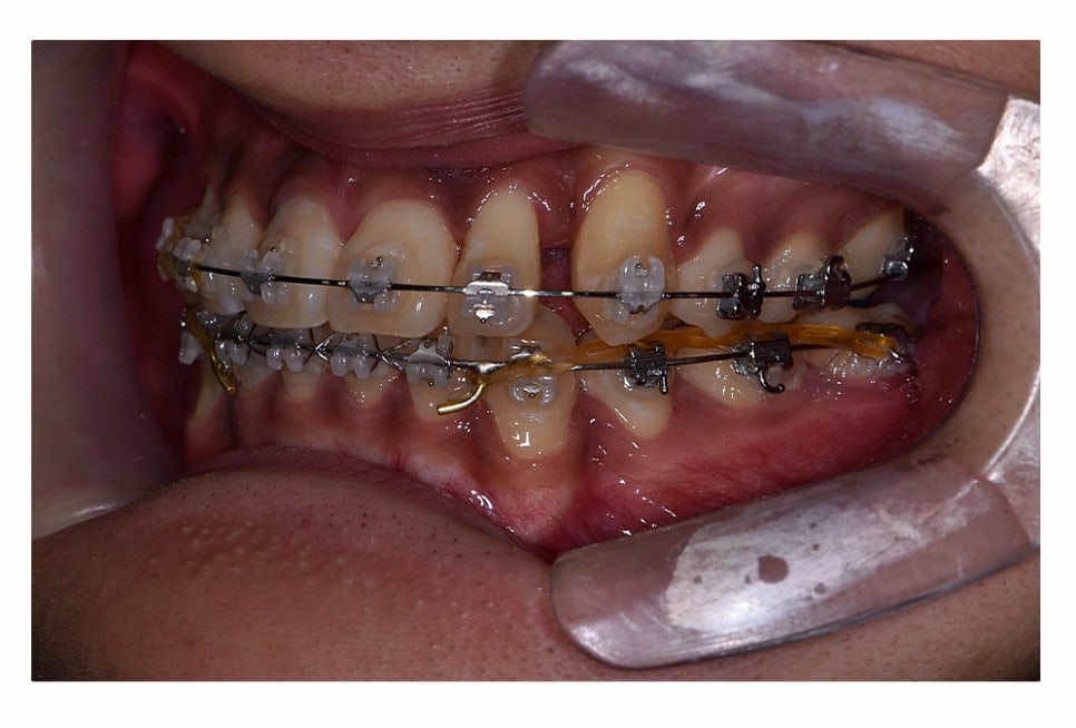 덧니 발치 필수적으로 하는건가요 관련 이미지 17