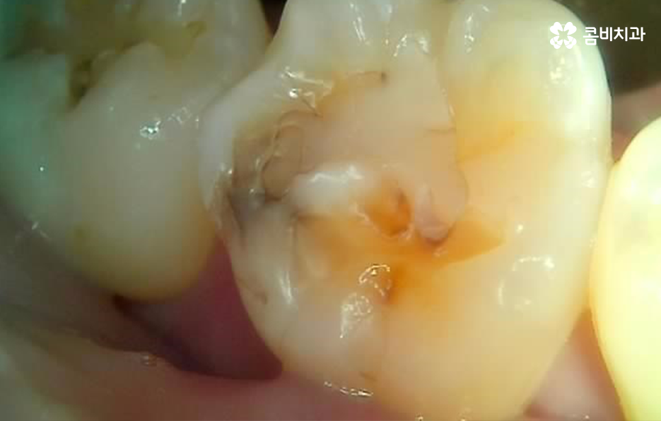 어금니 레진 깨짐 변색 안아파도 이렇게 대처하세요 관련 이미지 1