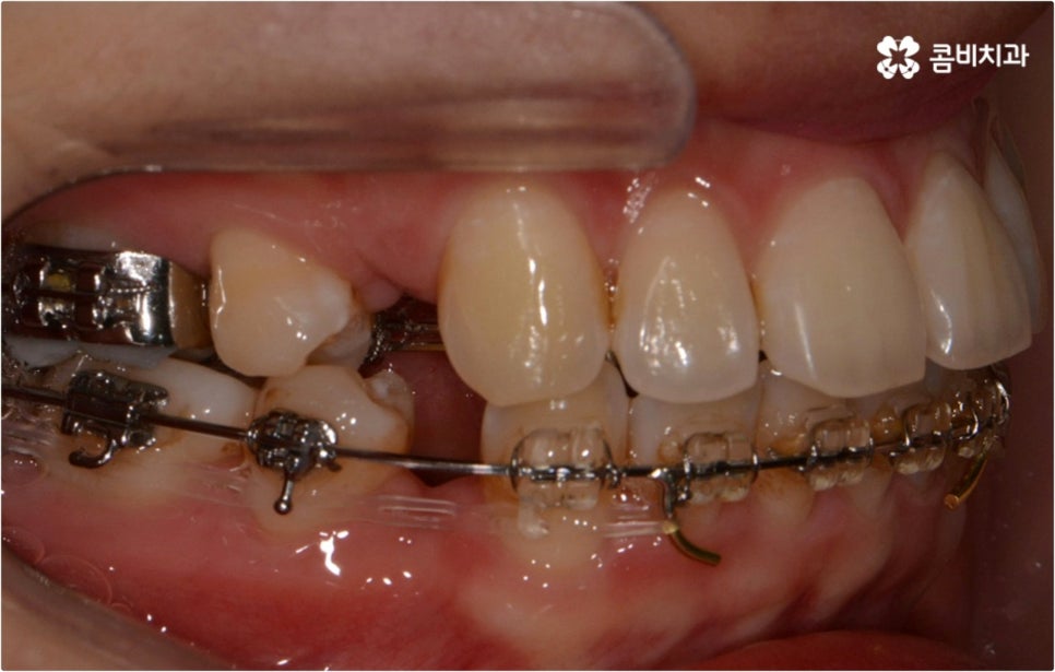 돌출입 치아교정 부모와 아이가 함께 알아봐요 관련 이미지 7