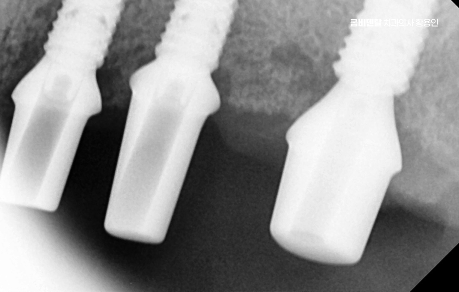 50대임플란트 꼼꼼하게 따져봐야할 포인트는 관련 이미지 9