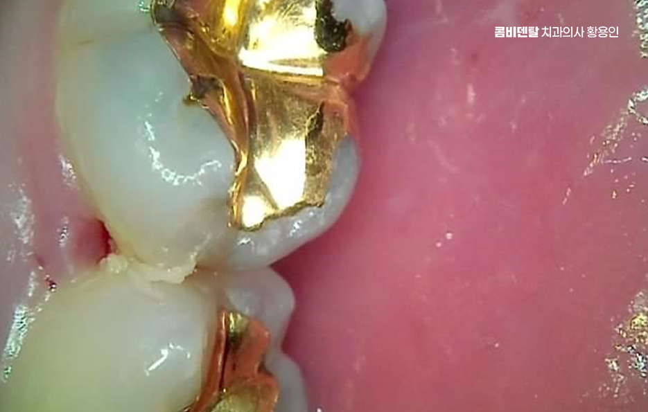 어금니 뒤 잇몸 부음 어떤 문제길래 이런거죠 관련 이미지 3