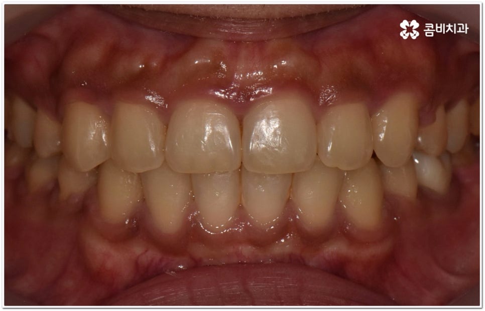 돌출입교정치과 알아보는 기준은 관련 이미지 14