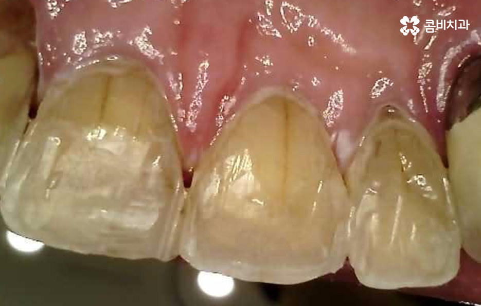 발치후 임플란트 기간 현실적으로 알아보면 관련 이미지 6