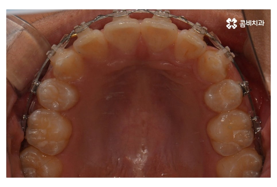 중학생치아교정 세심하게 체크하려면 관련 이미지 13