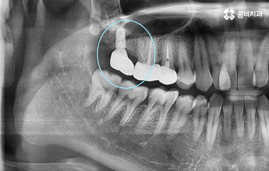 어금니 충치 발치 결국 뽑아야 할때와 살릴 수 있는 케이스 관련 이미지 10