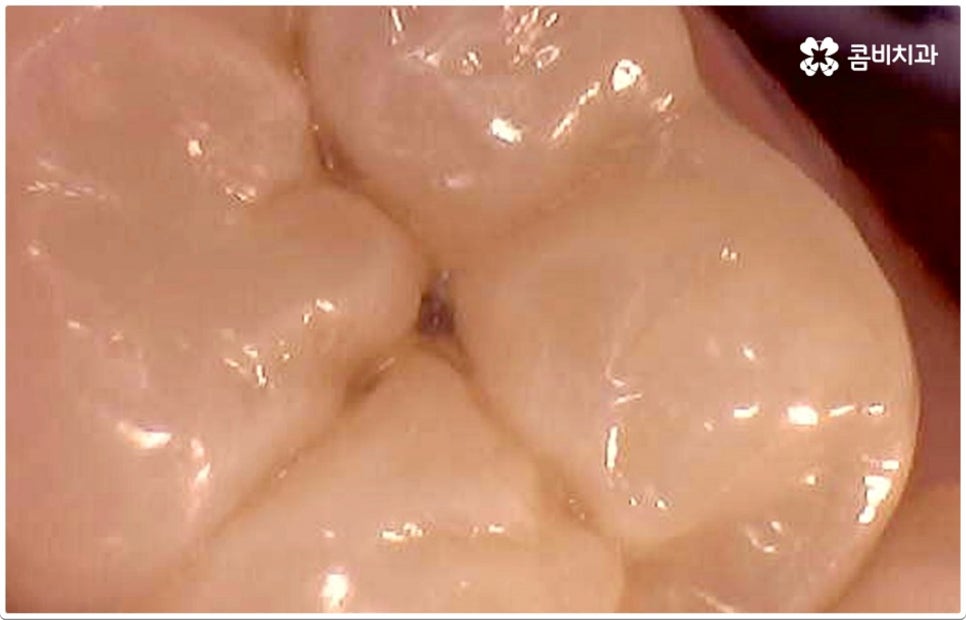 치아사이충치 놔두면 안돼요 관련 이미지 7