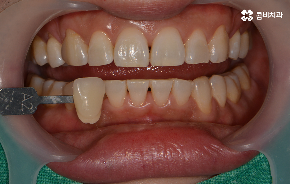치과미백치료 누런 이가 고민되신다면 관련 이미지 5
