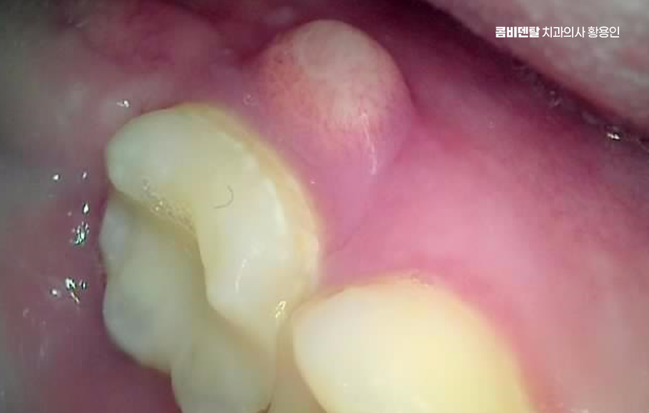 어금니 뒤 잇몸 부음 어떤 문제길래 이런거죠 관련 이미지 5