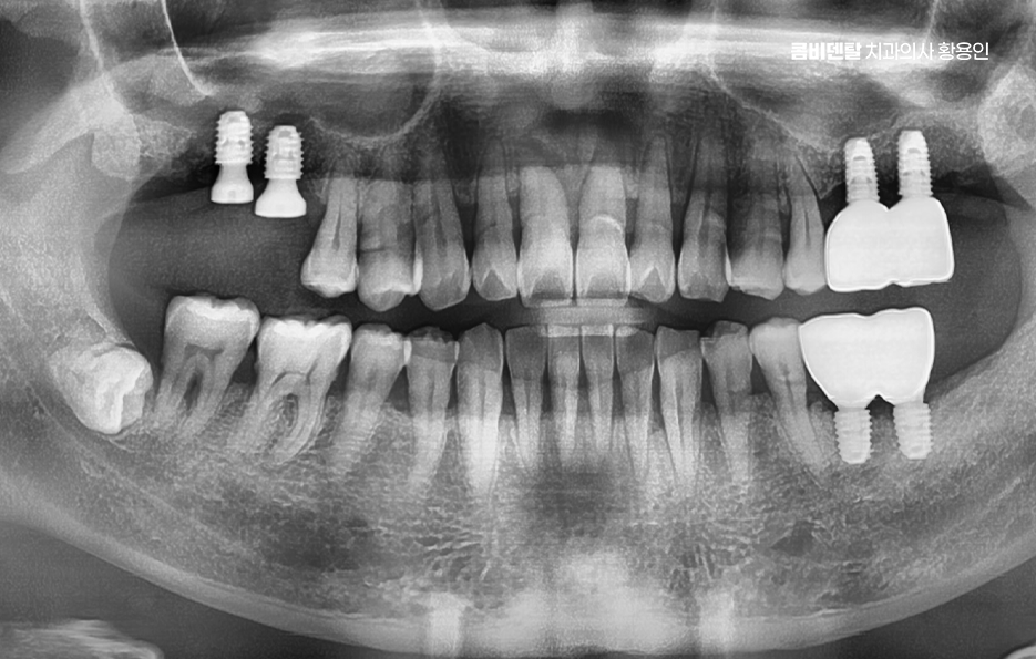어르신 임플란트 지원 현명하게 활용하려면 관련 이미지 9