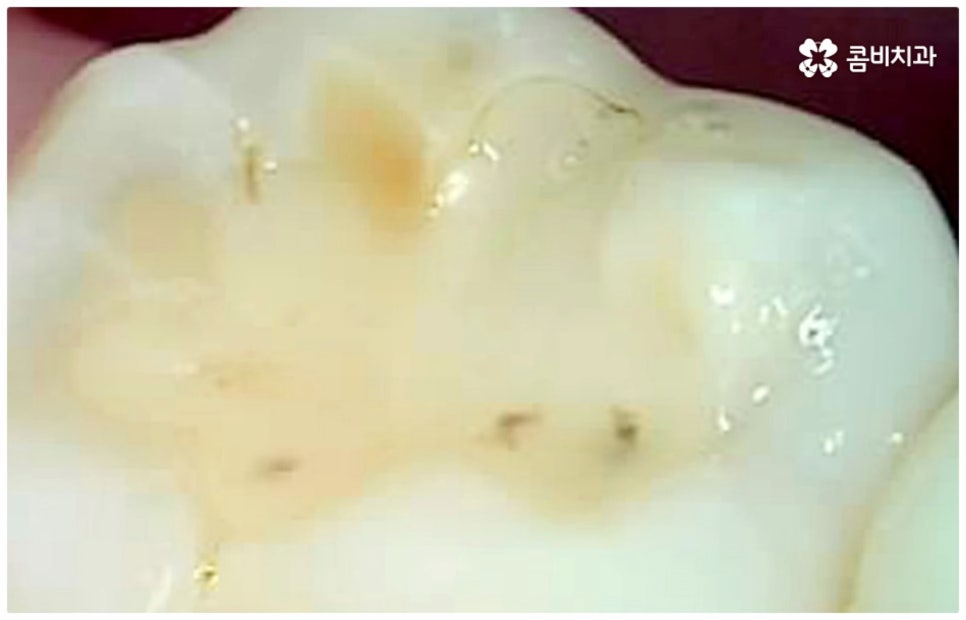어금니충치치료 아프다면 빨리 관련 이미지 11
