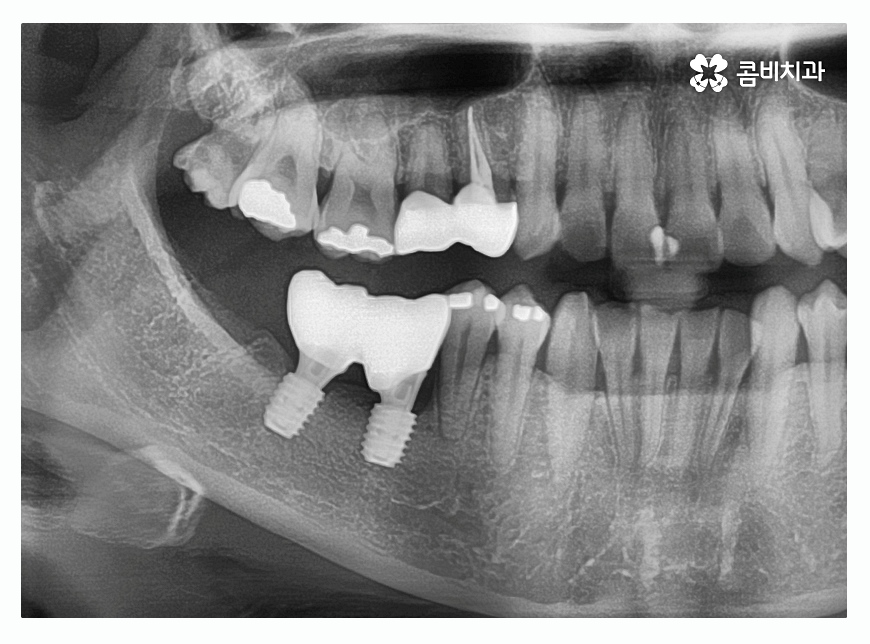 임플란트종류 잘알아보고 적용하려면 관련 이미지 8