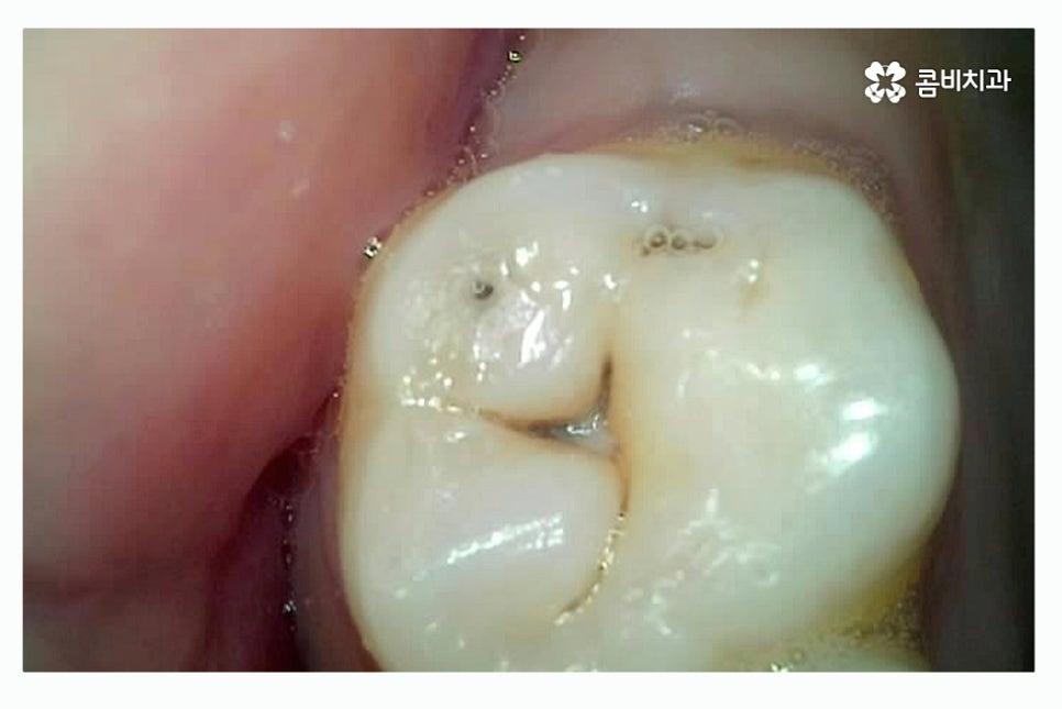 충치 레진 인레이 합리적으로 결정하려면 관련 이미지 1