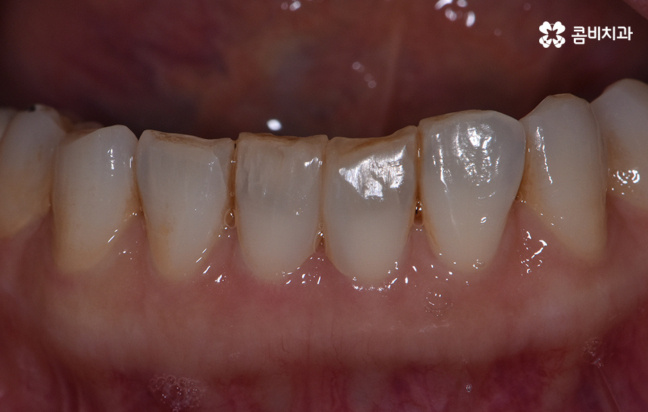 블랙트라이앵글 레진으로 해결한 사례 관련 이미지 4