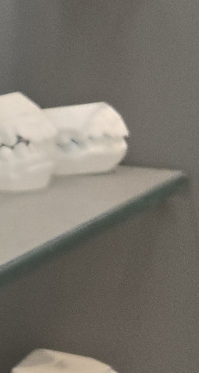 앞니 틀어짐 부분교정 얼마나 걸릴까 관련 이미지 39