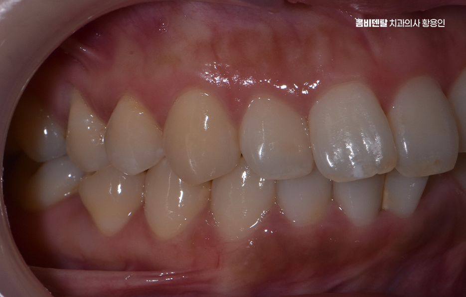 앞니 부분 교정 간단하니까 좋은건가요 관련 이미지 3