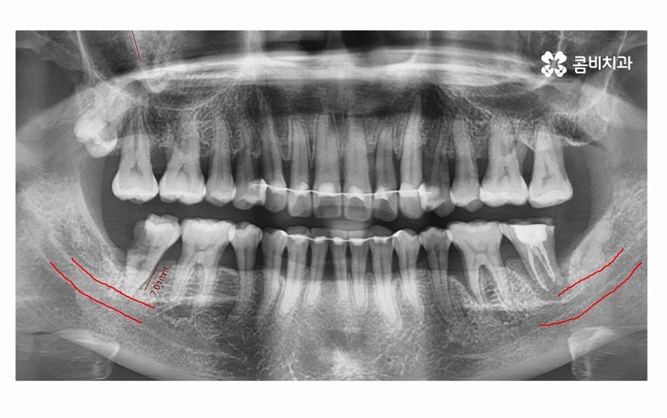 어금니 발치 심각해지기 전에 막으려면 관련 이미지 8