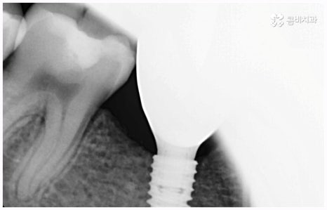 임플란트 종류 어떤게 맞을까요? 관련 이미지 9