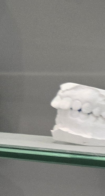 윗니 전체 임플란트 뭐부터 해야할까 관련 이미지 23