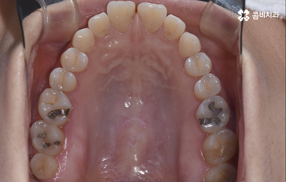 중년치아교정 이제라도 해도 될까요 관련 이미지 5