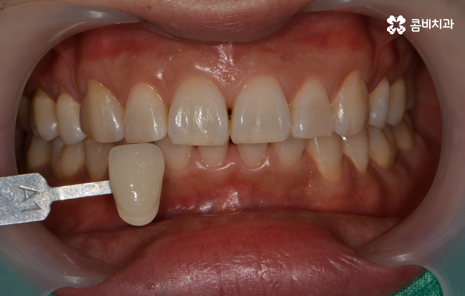 치과미백치료 누런 이가 고민되신다면 관련 이미지 4