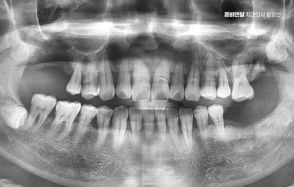 어르신 임플란트 지원 현명하게 활용하려면 관련 이미지 1