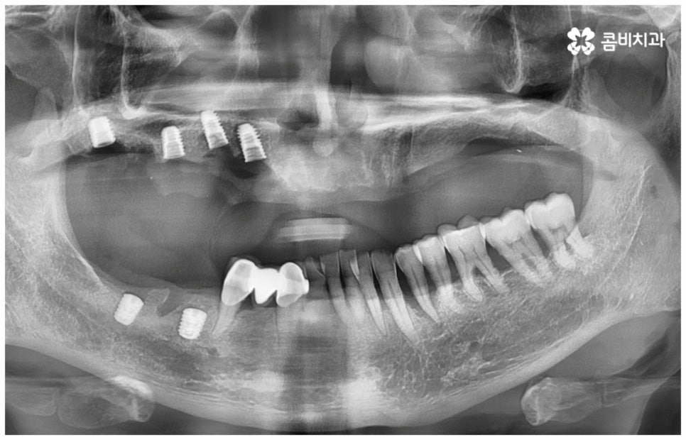 임플란트수명 연장하려면? 관련 이미지 9