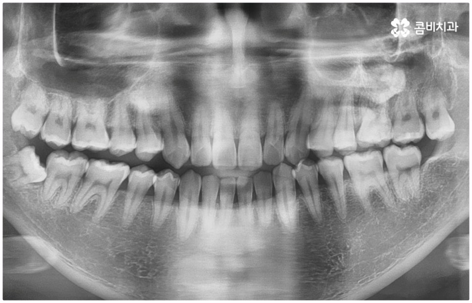 부정교합 3급 왜 고쳐야 하나요 관련 이미지 2