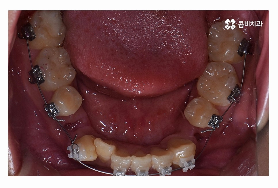 덧니 발치 필수적으로 하는건가요 관련 이미지 11