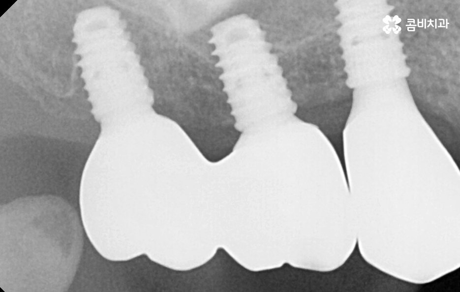 임플란트 치료기간 어느정도 걸리고 치과에는 몇번 가나요 관련 이미지 10