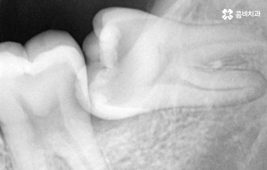 부분매복 사랑니 발치 신중하게 대비하려면 관련 이미지 3