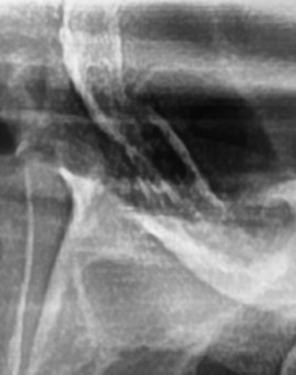 어금니 뒤 잇몸 부음 어떤 문제길래 이런거죠 관련 이미지 16