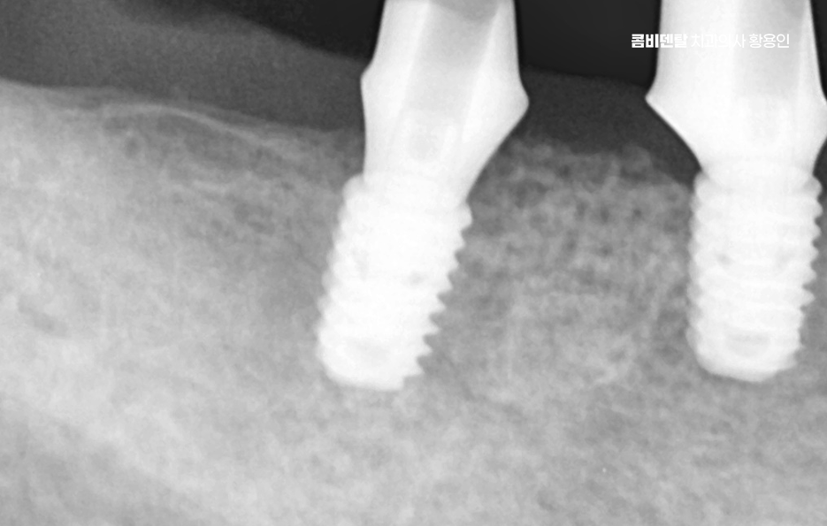 치아 발치 후 임플란트 언제부터 준비할까 관련 이미지 9