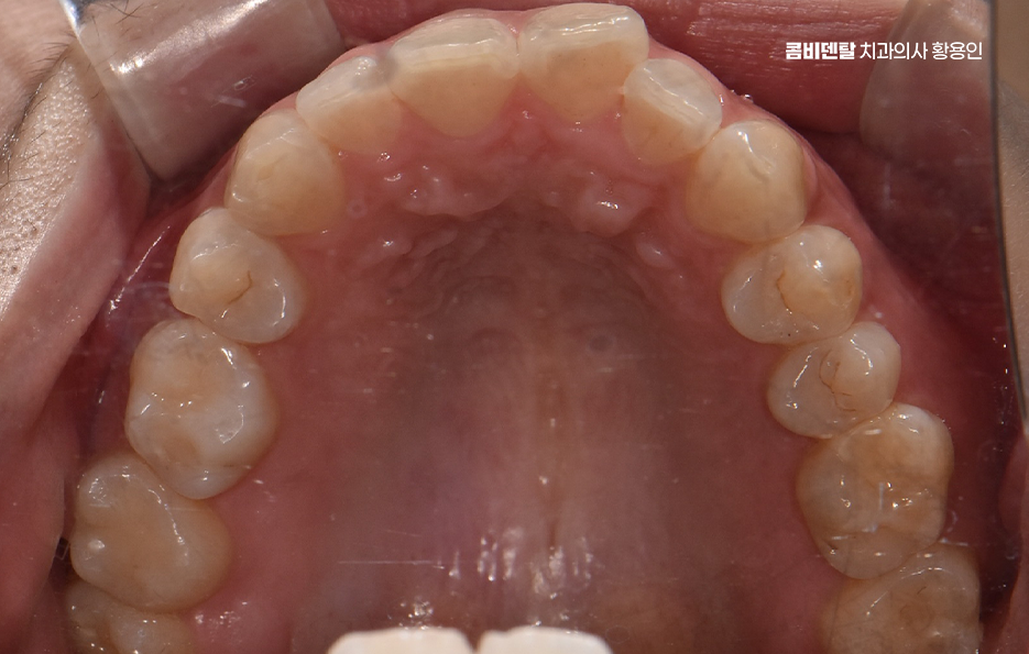 앞니 틀어짐 교정 이렇게 파악하세요 관련 이미지 6