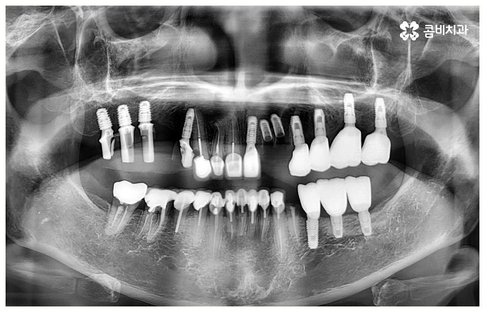 임플란트 치료기간 중점을 두어야 할것은 관련 이미지 8