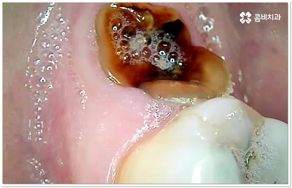 어금니 충치치료 빠를수록 좋아요 관련 이미지 5
