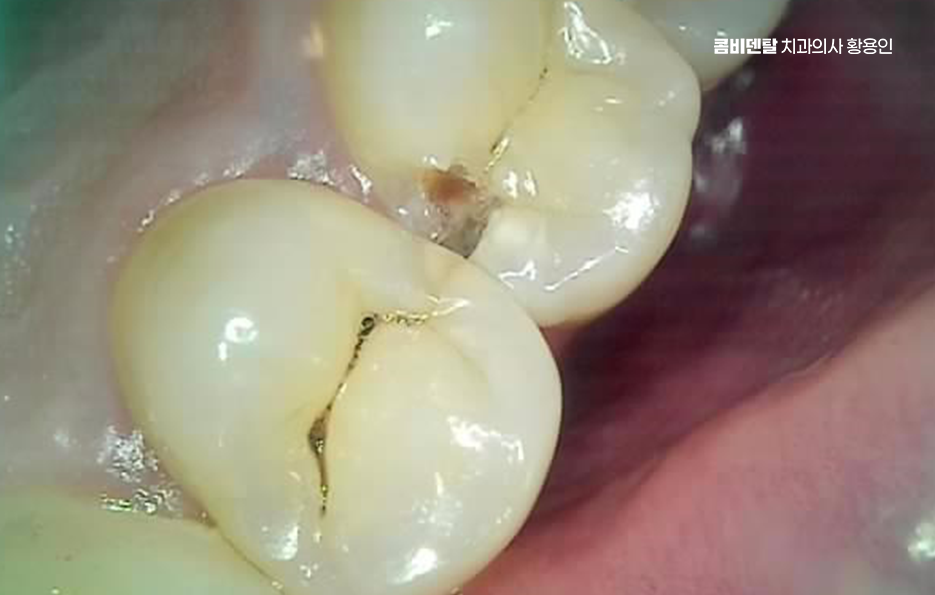 충치 치아 깨짐 시점이 관건이라면 관련 이미지 3