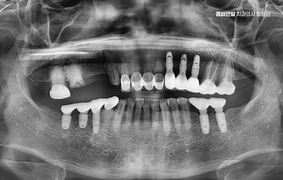어금니 임플란트 안하면 후회하게 되는걸까 관련 이미지 6