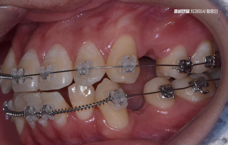 송곳니 덧니 발치 이럴때 해당되네요 관련 이미지 9