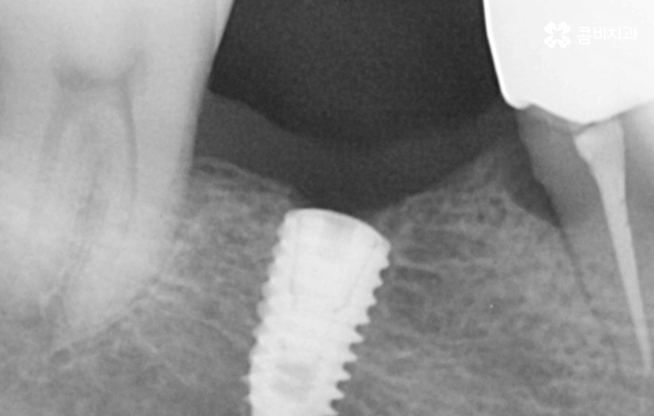 노인임플란트 이때부터 특히 조심하세요 관련 이미지 10