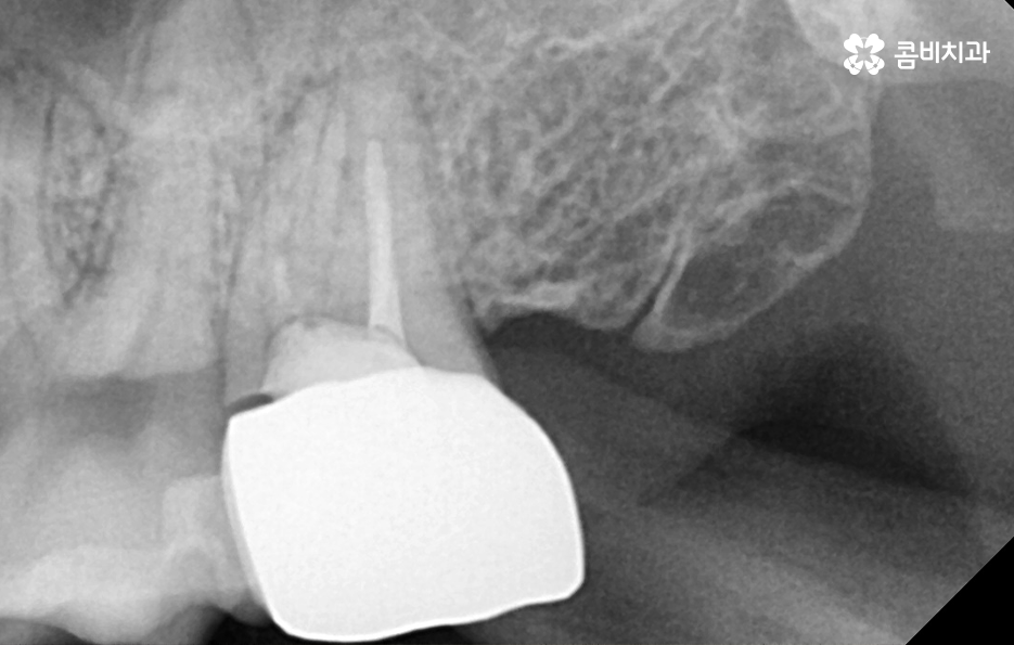 어금니 발치후 임플란트 이런점을 주의합시다 관련 이미지 5