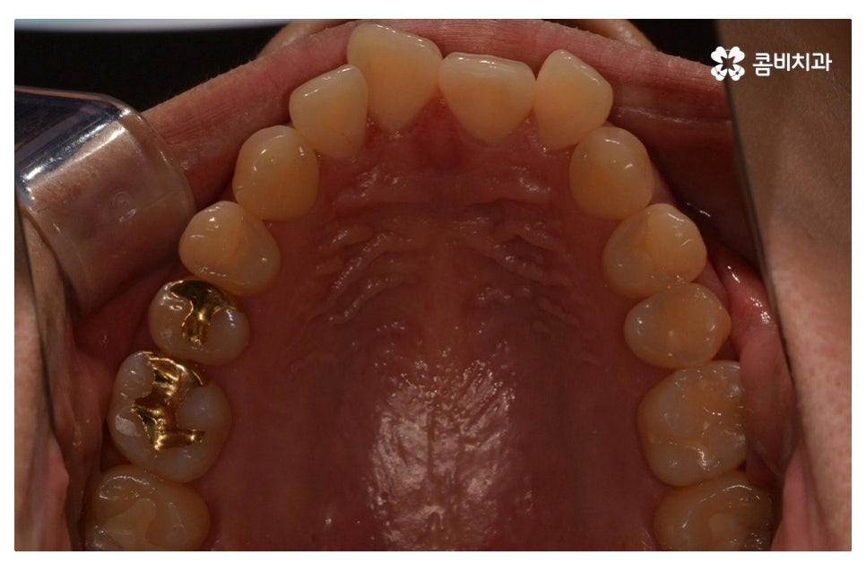덧니교정 정확하게 알아보려면 관련 이미지 2