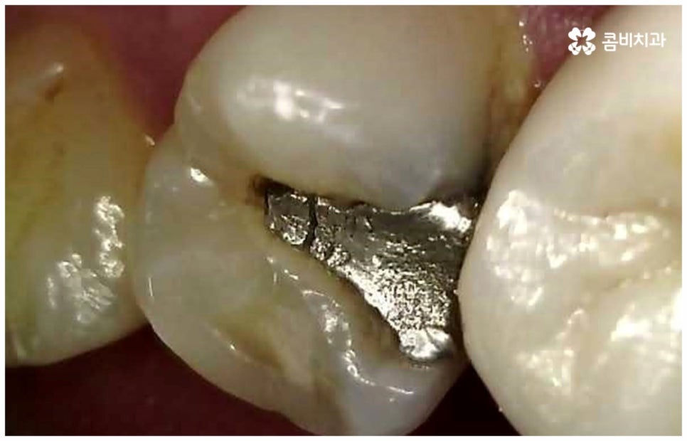 어금니신경치료 케이스마다 달라요 관련 이미지 7