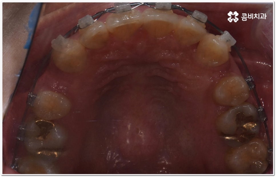 돌출입교정치과 알아보는 기준은 관련 이미지 12