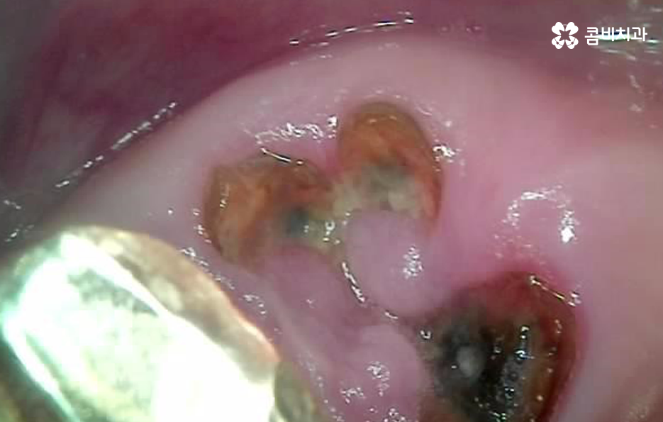 임플란트 치조골 상태에 따라 치료 계획도 달라지나요 관련 이미지 3