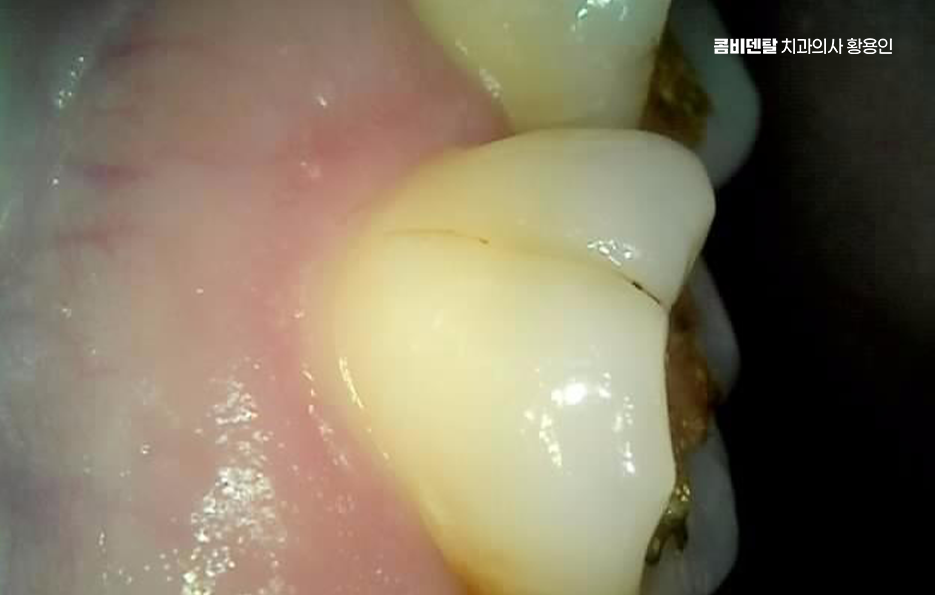 인레이 치료 후 통증 자꾸 심해지는데 괜찮은걸까 관련 이미지 4