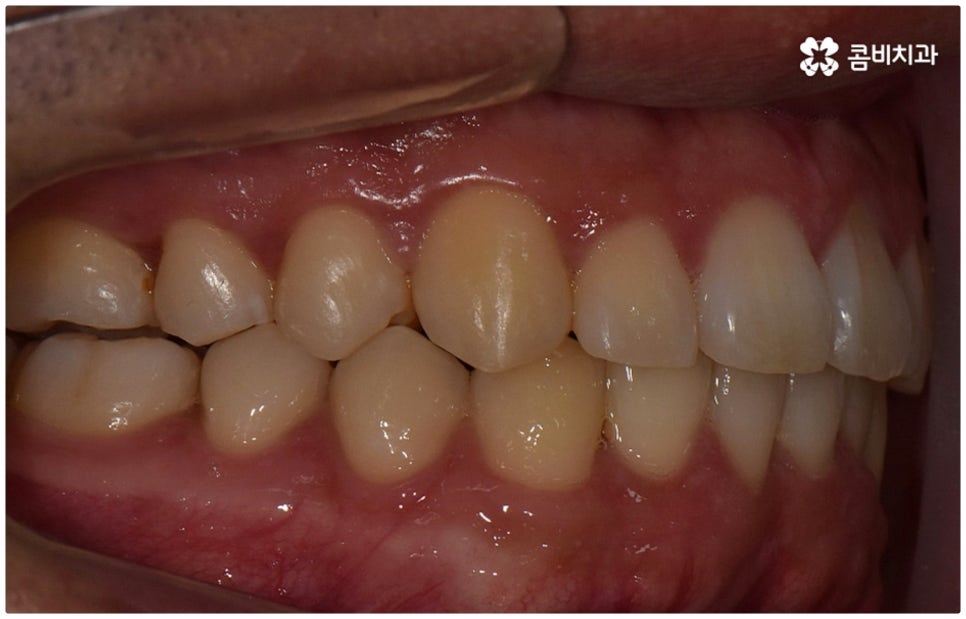 부정교합 3급 왜 고쳐야 하나요 관련 이미지 14