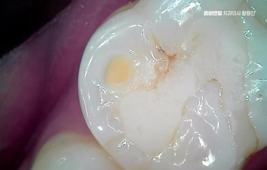 명동치과 흔하게 놓치는 사례를 정리해요 관련 이미지 10