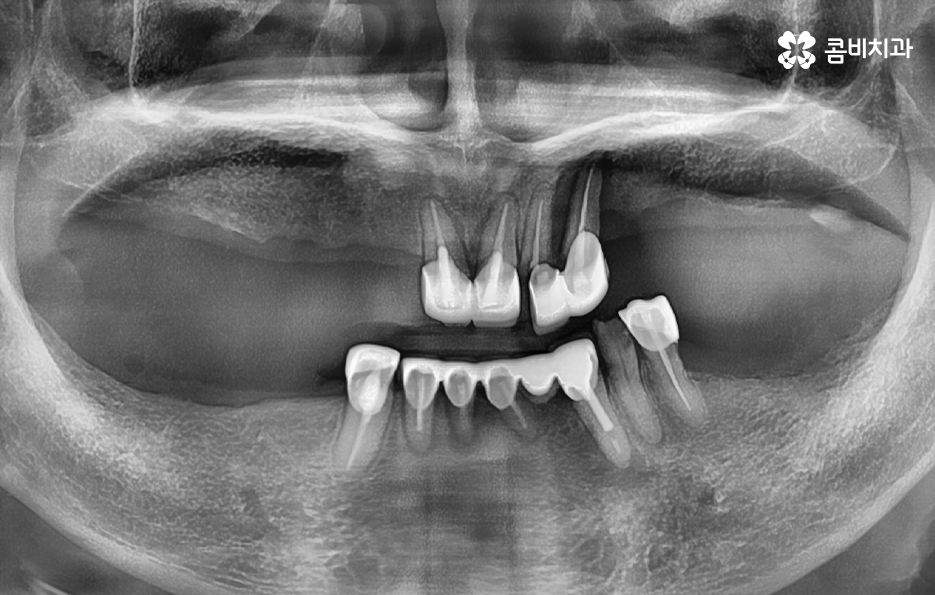 임플란트 나이 얼마나 영향을 줄까 관련 이미지 1